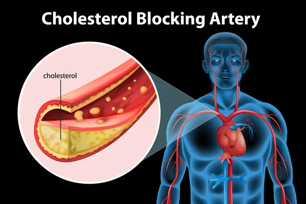 Angina Vector Art Stock Images | Depositphotos