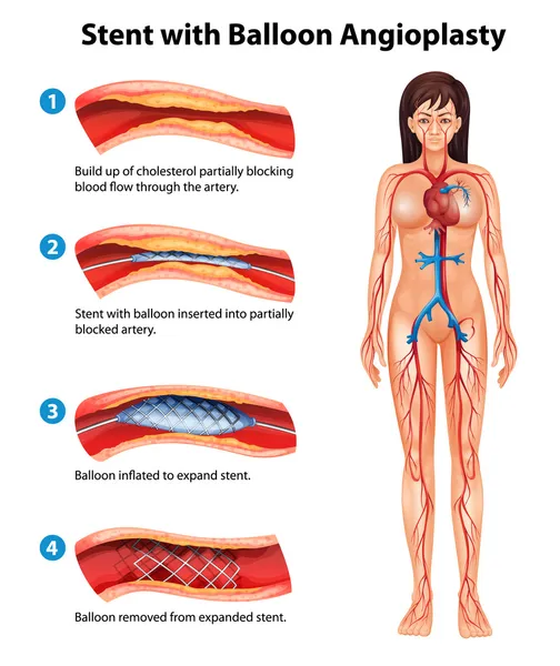 Stent anjiyoplasti işlemi — Stok Vektör