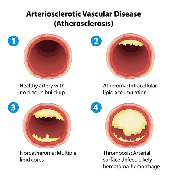 Атериосклероз
