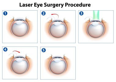 lazer göz cerrahisi prosedürü