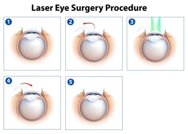 Laser Eye Surgery Procedure clipart