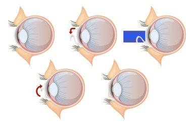 Laser eye correction clipart