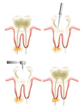 Root canal procedure clipart