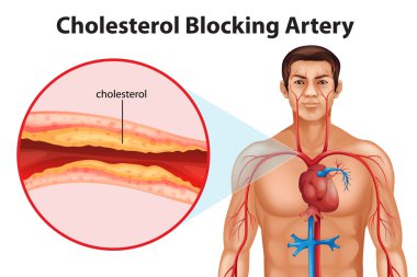 Ateriosclerosis clipart