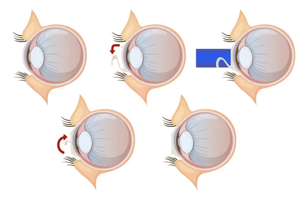 Correzione dell'occhio laser — Vettoriale Stock