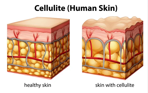 Cellulite — Stockvektor