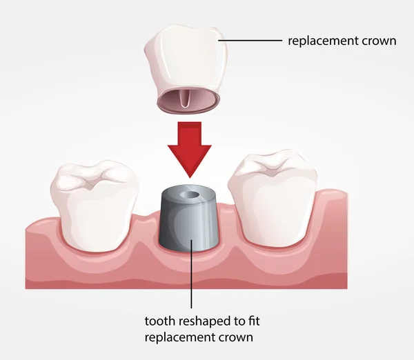 Procedura corona dentale — Vettoriale Stock