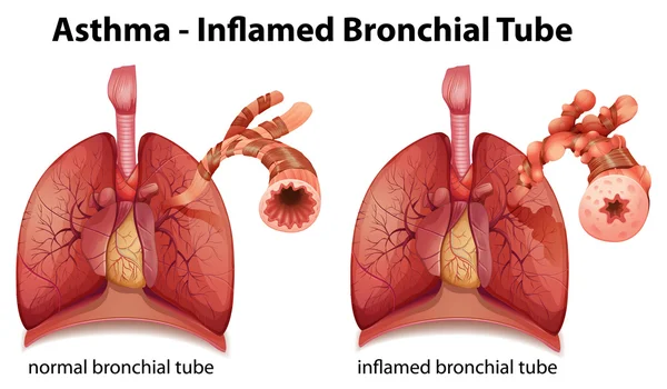 Asthma — Stockvektor