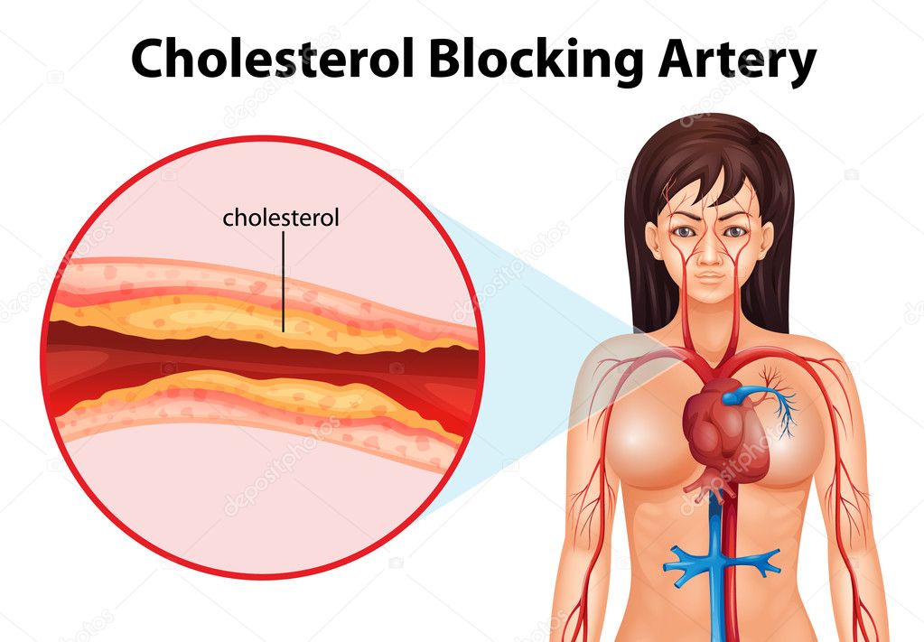 Ateriosclerosis