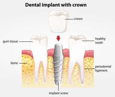 Dental implant with crown clipart