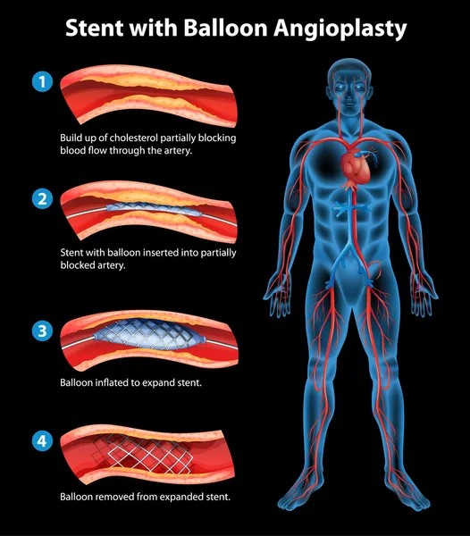 Procedimiento de angioplastia con stent — Vector de stock