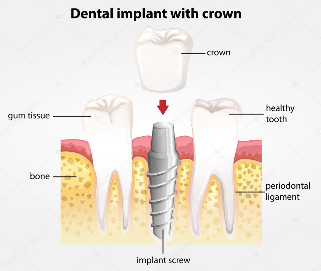 Dental implant with crown