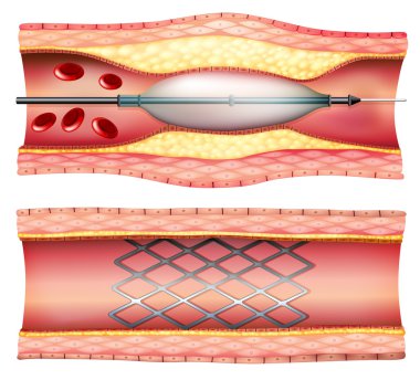 Stent Angioplasty clipart