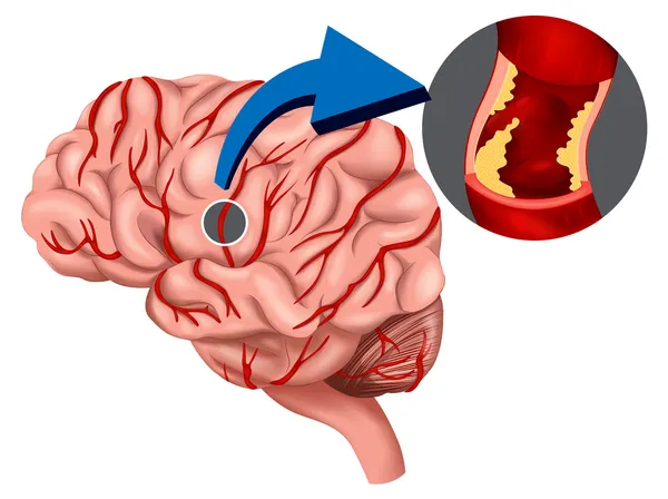 Caillot de sang concept dans le cerveau — Image vectorielle