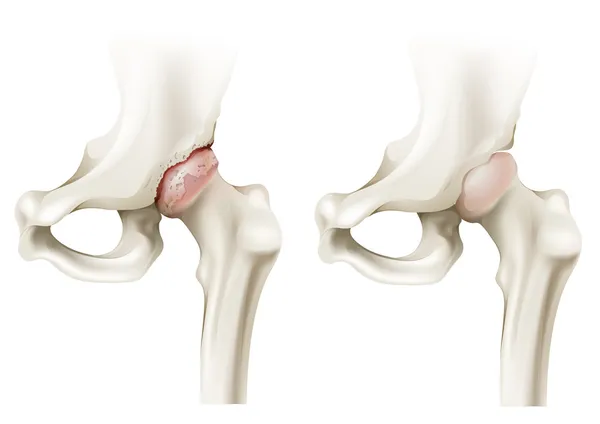 Hip arthritis — Stockový vektor