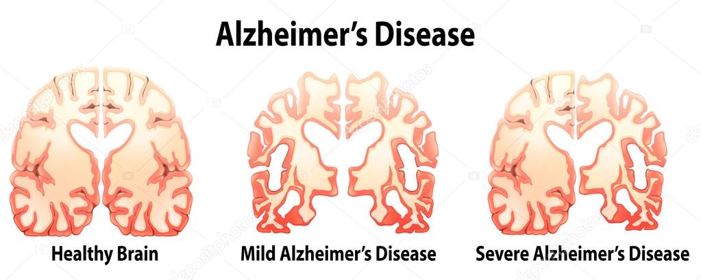 Alzheimer's Disease