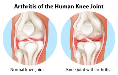 Arthritis of the human knee joint clipart