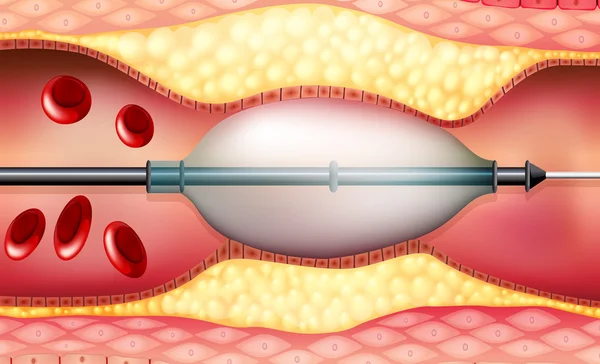 Stent — Stockvektor