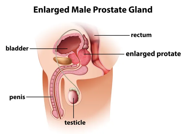 Enlarged male prostate gland — Stock Vector