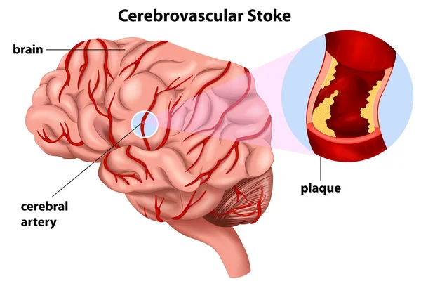 Cerebrovasculaire beroerte — Stockvector