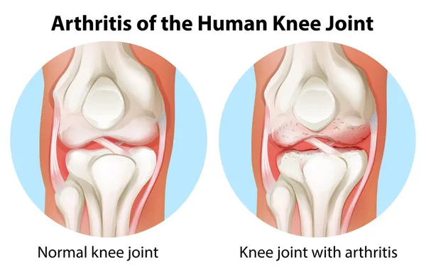 Artritis de la articulación de la rodilla humana — Archivo Imágenes Vectoriales