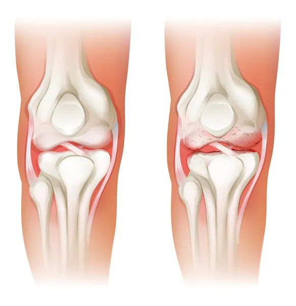 Human knee arthritis — Stock Vector