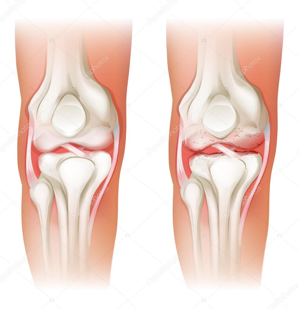 Human knee arthritis