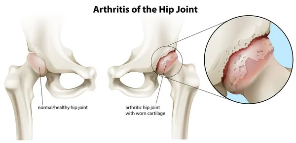 Arthritis of the hip joint — Stock Vector