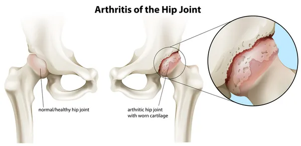 Artritis de la articulación de cadera — Archivo Imágenes Vectoriales