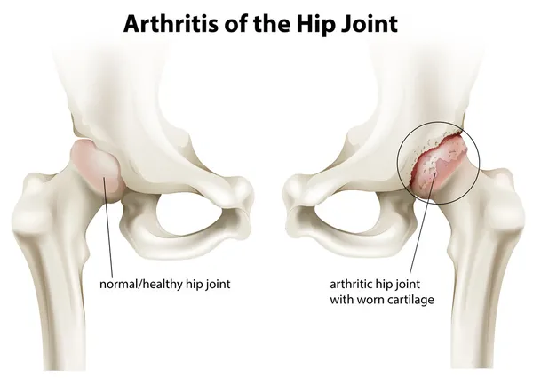 Arthritis of the hip joint — Stock Vector