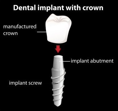 taç ile bir diş implantı