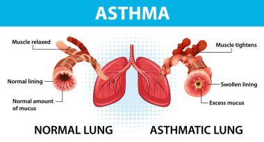 Bronşiyal astım diyagramı ve normal akciğer ve astım çizimi.