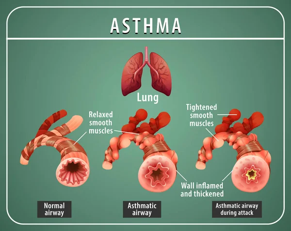 Diagramma Asma Con Vie Aeree Normali Illustrazione Asmatica Delle Vie — Vettoriale Stock