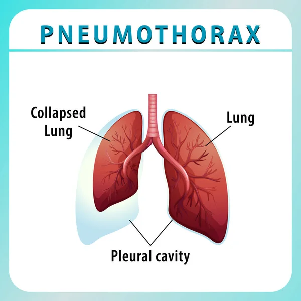 Diagramme Pneumothorax Avec Poumon Effondré Illustration Pulmonaire Saine — Image vectorielle