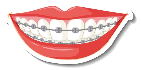 白い背景のイラストのブレースの歯 — ストック写真