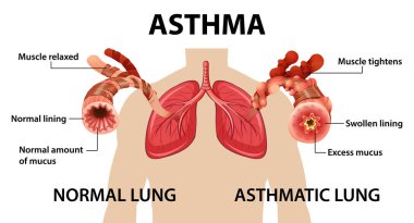 Bronşiyal astım diyagramı ve normal akciğer ve astım çizimi.