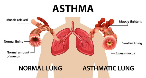 Bronchiaal Astma Diagram Met Normale Long Astmatische Longillustratie — Stockvector