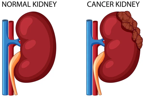 Rinichi Cancer Ilustrație Renală Normală — Vector de stoc