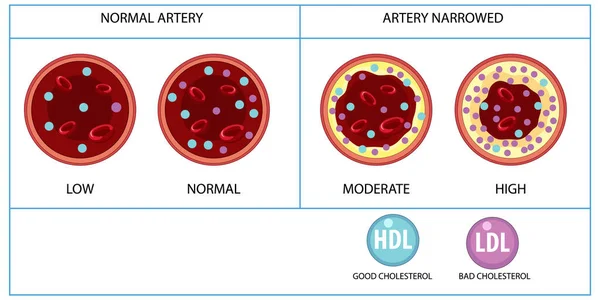 Abbildung Der Arten Von Cholesterin Hdl Und Ldl — Stockvektor