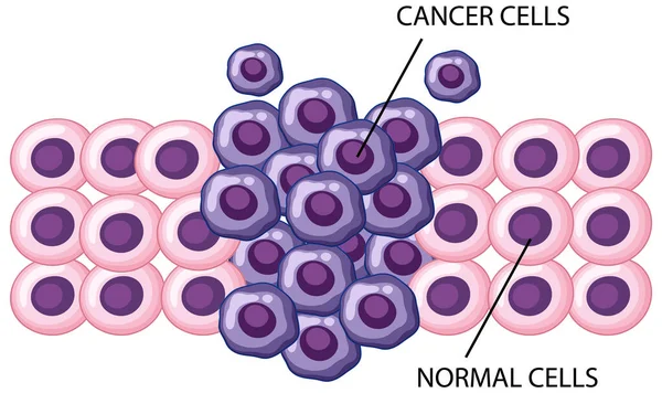 Procesul Dezvoltare Celulelor Canceroase Ilustrare — Vector de stoc