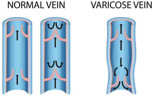 Сравнение Нормальной Вены Варикозным Расширением Вен — стоковый вектор