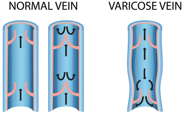 Confronto Tra Vena Normale Illustrazione Della Vena Varicosa — Vettoriale Stock