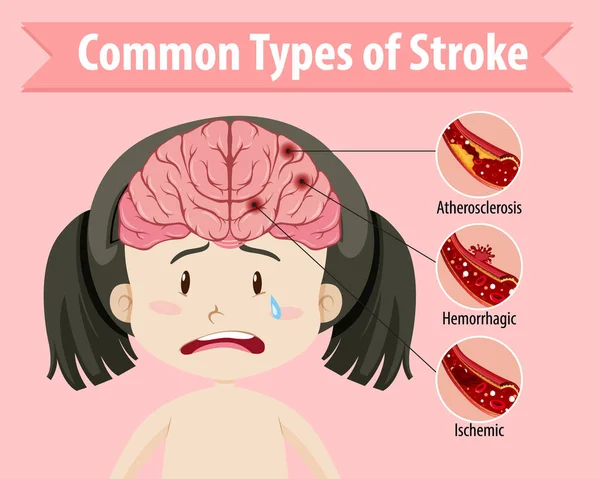 Humano Com Tipos Comuns Ilustração Acidente Vascular Cerebral — Vetor de Stock