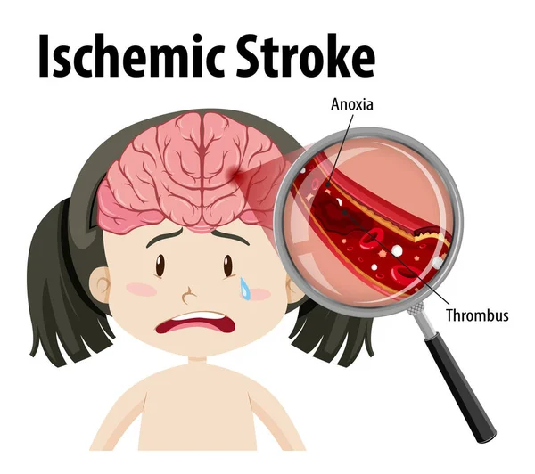 Mänsklig Med Ischemisk Stroke Illustration — Stock vektor