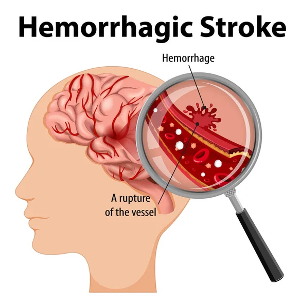 Human Hemorrhagic Stroke Illustration — Stock Vector