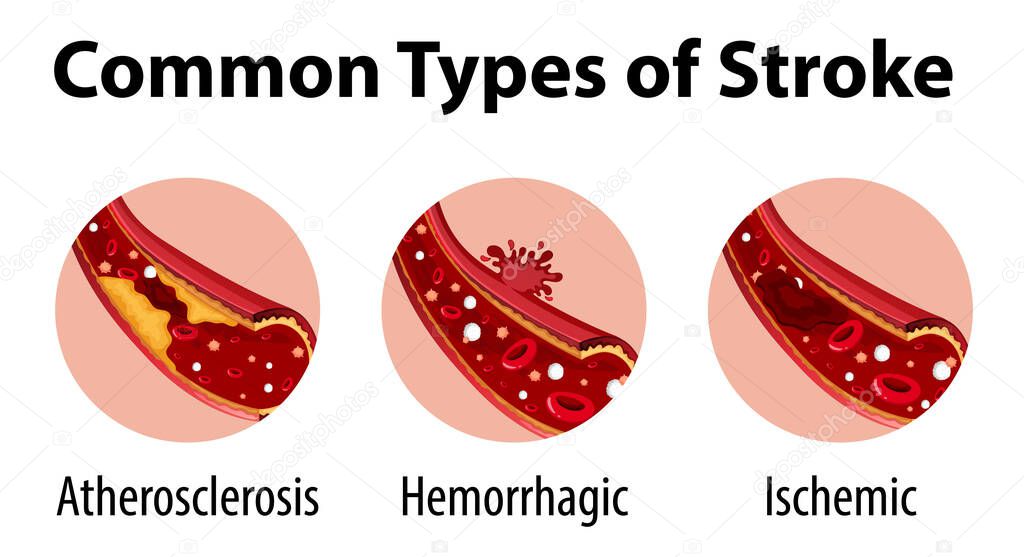 Infographic of common types of stroke illustration