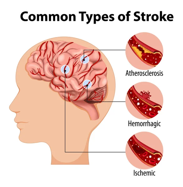 Human Hemorrhagic Stroke Illustration Stock Vector by ©blueringmedia