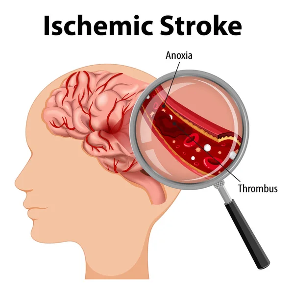 Illustrazione Umana Con Ictus Ischemico — Vettoriale Stock