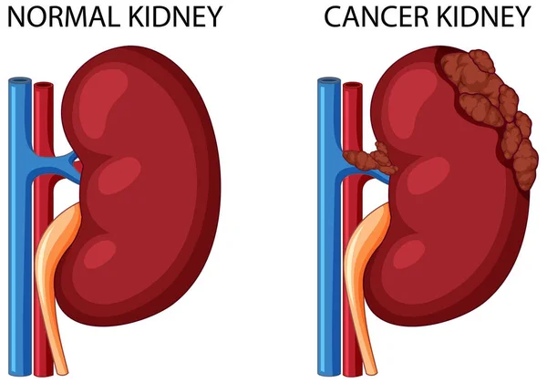 Illustrazione Normale Del Rene Del Cancro Rene — Vettoriale Stock