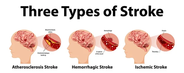 Infográfico Tipos Comuns Ilustração Acidente Vascular Cerebral —  Vetores de Stock